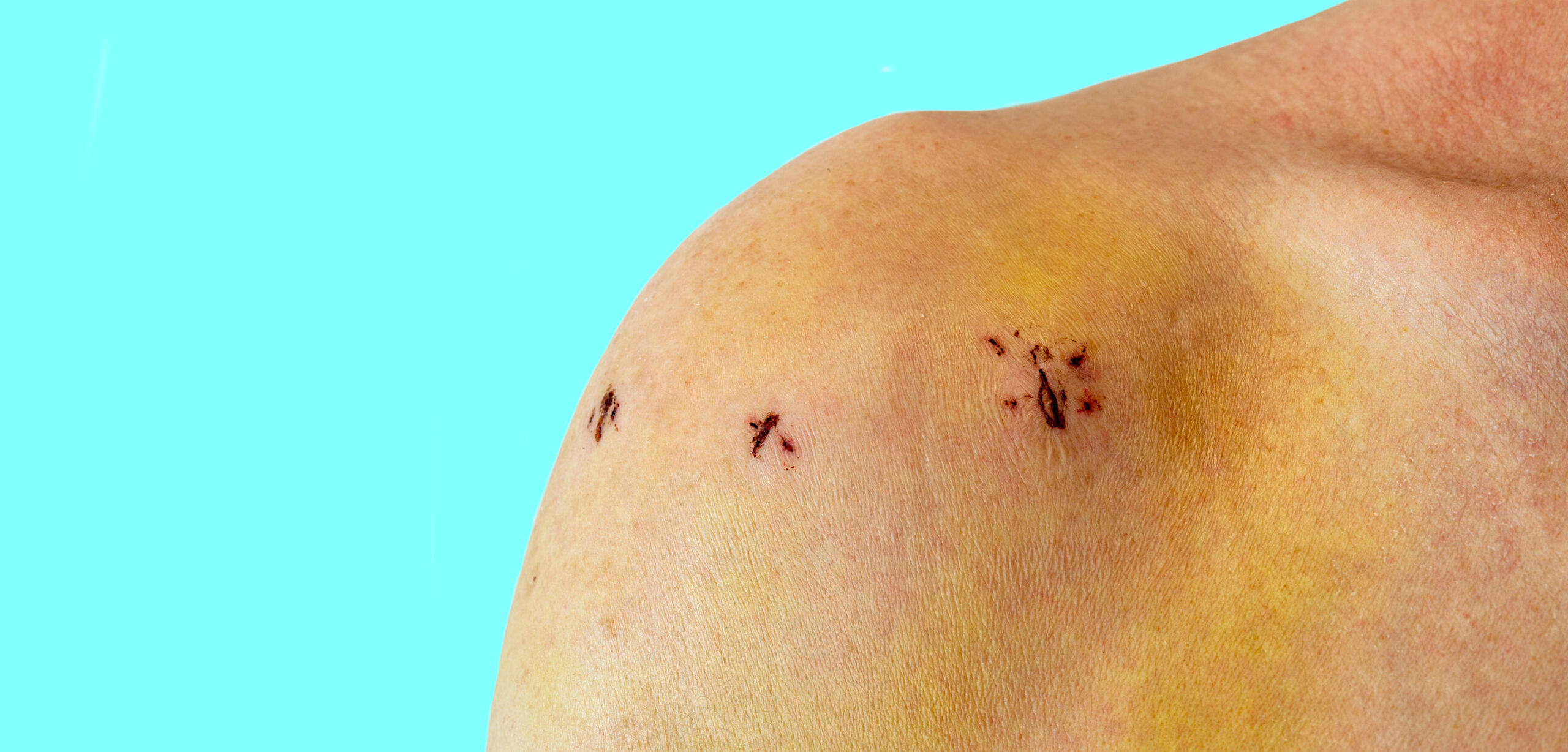 After a shoulder arthroscopy surgery, recovery takes approximately 1 to 2 weeks.
