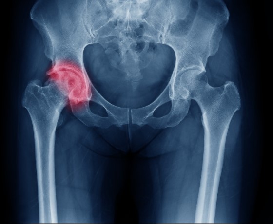 Hip treatment in Melbourne